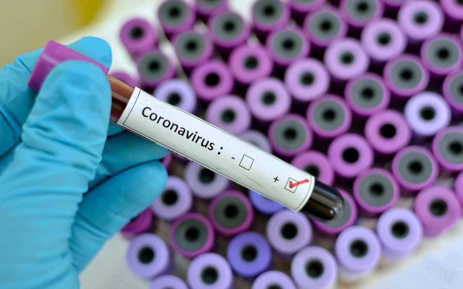 Cinco cosas que debe saber del COVID-19 o “coronavirus”