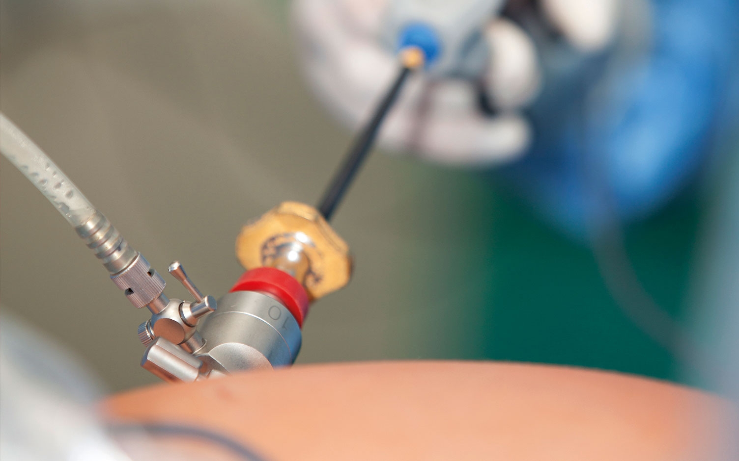 Cirugía ginecológica laparoscópica: una opción mínimamente invasiva
