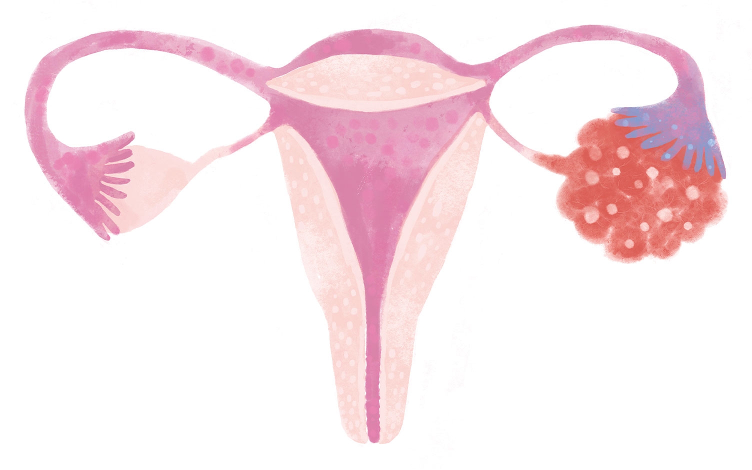 Vivir con síndrome de ovario poliquístico